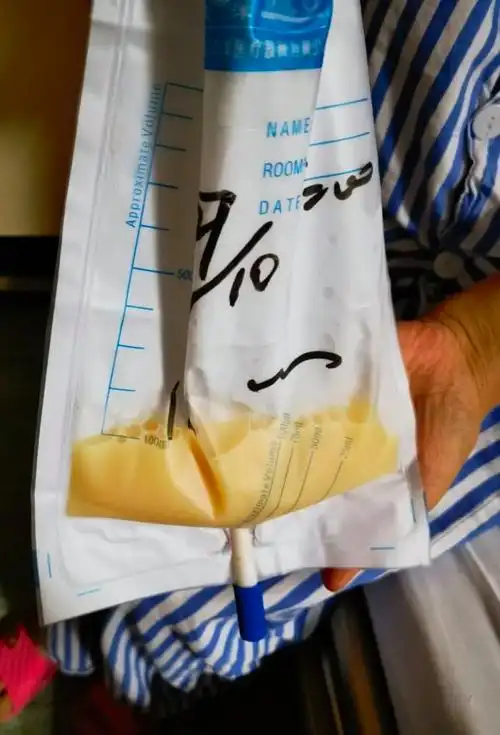 27岁小伙每天产"奶"2斤,竟是这里漏了|淋巴液|乳糜|浙大一院|淋巴