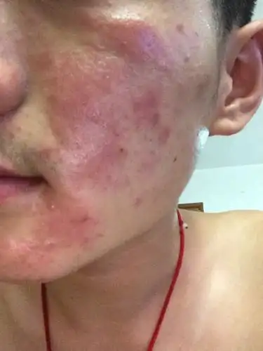 皮肤过敏 瘙痒 硬块状.还皮肤干燥