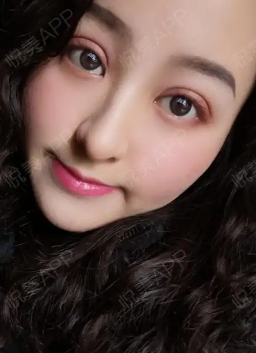 下睑下至术后20天_眼部多项术后20天_全切双眼皮术后20天_眼型矫正术