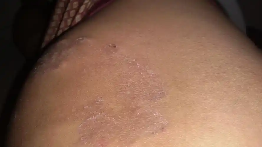 屁股上有皮肤病 很痒很痒.