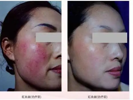 北京看红血丝医院哪家好-北京治疗红血丝医院排行-北京哪家医院治疗红