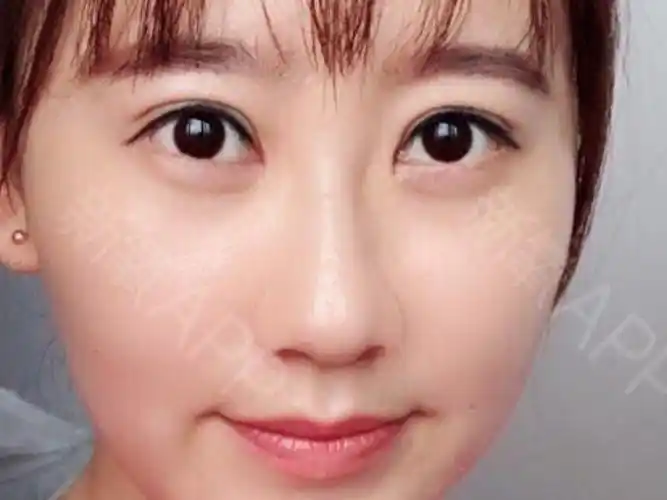 一年多前做的埋线双眼皮,结果慢慢松脱了,双眼皮也塌_圈子-新氧美容