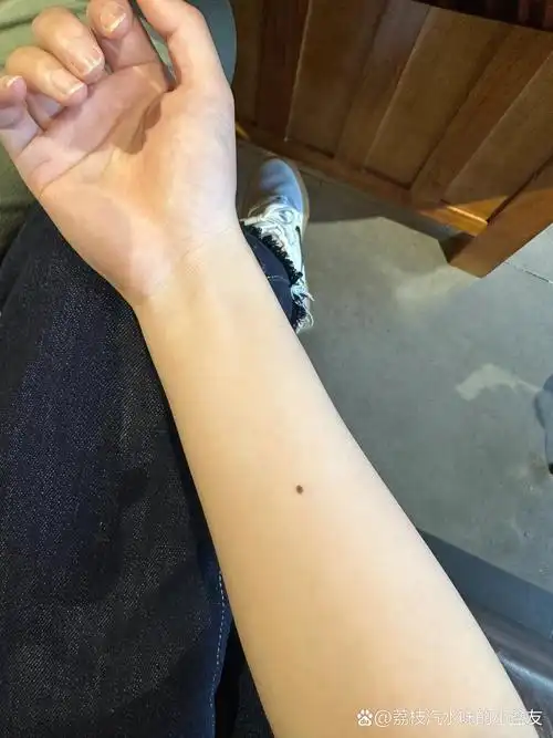 右手胳膊上的痣好喜欢 有的集合01