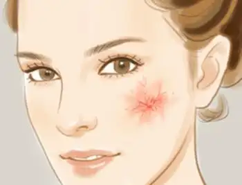 皮肤有红血丝需要注意什么?雅奇教你护肤