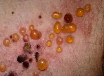 这种少见重症皮肤病,不恰当治疗会发到全身