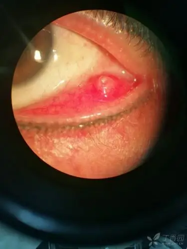 睑板腺囊肿 [病例帖]