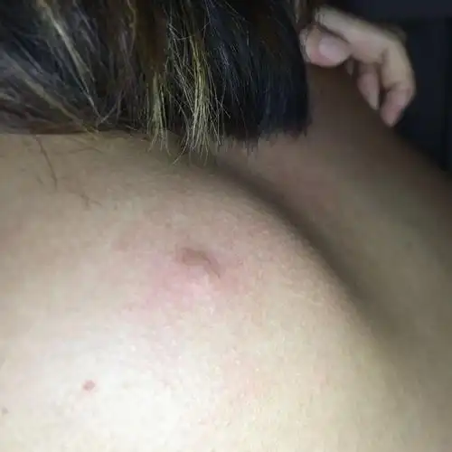 身上涨了一个大疙瘩,有10几年了.是什么东西,后背上的