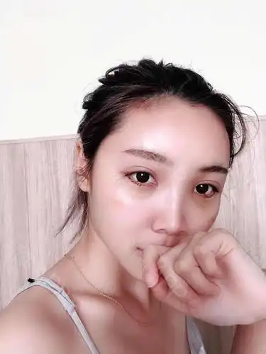 自体脂肪填充全脸