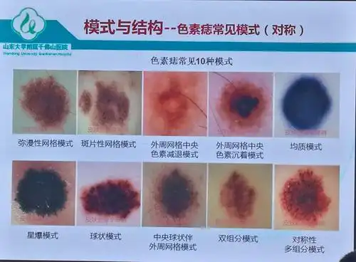 色素性疾病的皮肤镜表现(修改版)