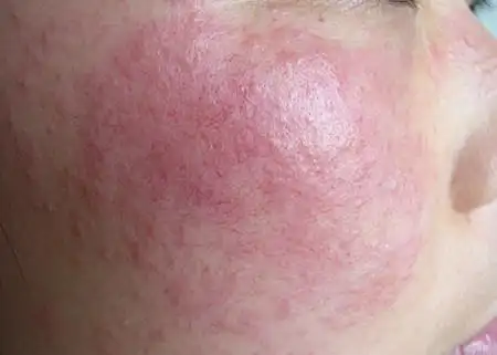 面部皮炎知多少