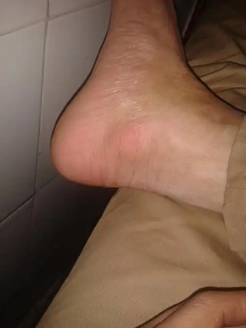 右脚脚掌的距骨位置,类似有一块软骨突出,用力按会痛,不知道怎么造成