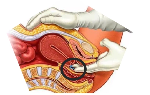 下图圆圈标记位置为后穹窿,即阴道放药的最佳位置.