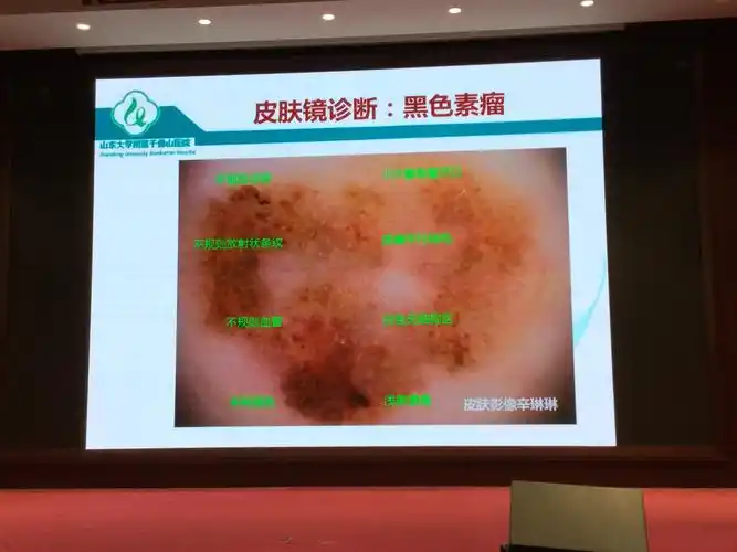黑素细胞皮肤肿瘤皮肤镜鉴别特点及要点 辛琳琳教授