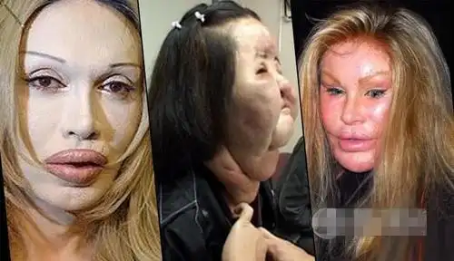但千万别遭了罪还没讨好,下面就来看看这些整容失败的惊悚案例
