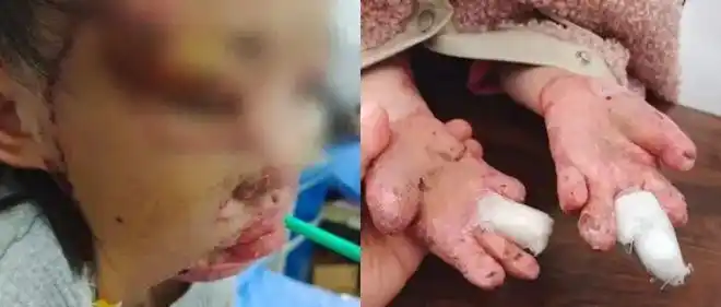 痛惜8岁女童意外烧伤毁容手指截肢