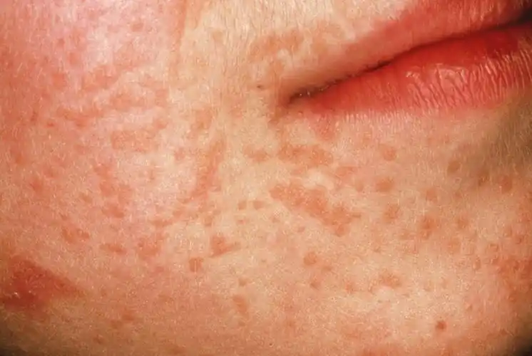 同学聚会后女子隐秘部位长菜花医生提醒要注意洁身自好