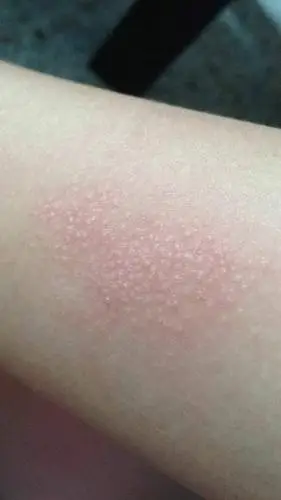 问:胳膊上出了些小疙瘩.有时候很痒.