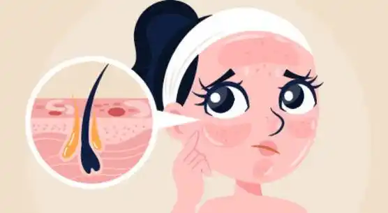 这些炎性因子会刺激皮脂腺分泌更多的油脂,以保护皮肤不受外界环境的