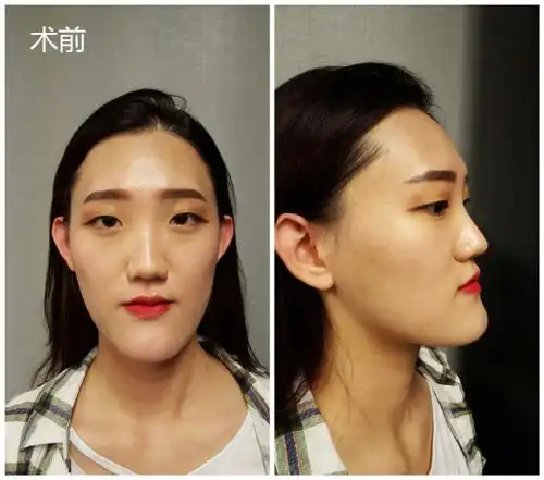 可以接受普通的韩国长脸矫正,包括修饰下颌角,下巴形状达到理想效果