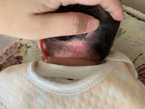 宝宝头背后有红色一片,请问这是什么来的?