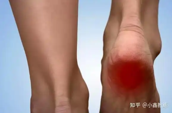 足底筋膜炎应该注意什么