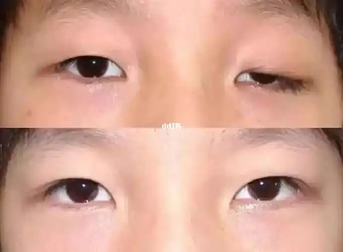 有研究者对3100例重症肌无力的临床分析发现,以眼睑下垂为首的发症状