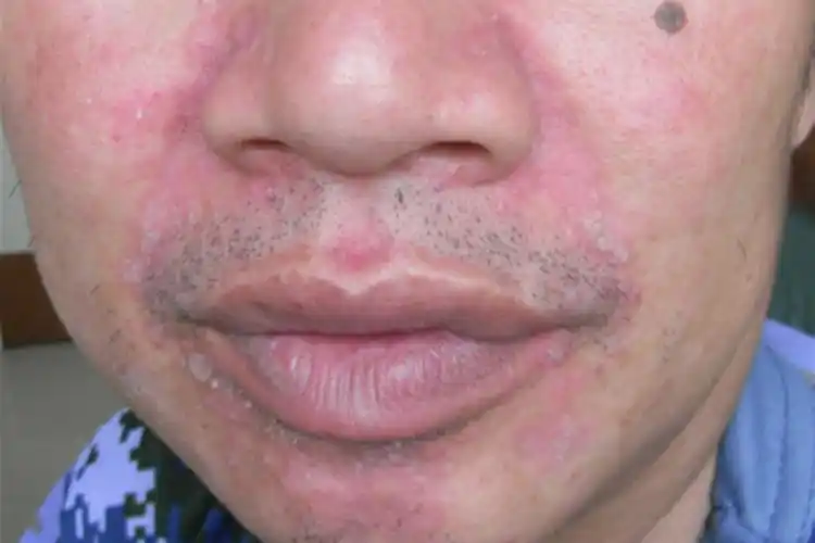 各部位皮损症状颈部反向银屑病4,反向银屑病:皮损为边界清楚的红斑,有