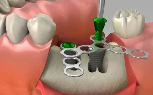 种植牙好还是活动牙好不同品牌的种植体有什么区别