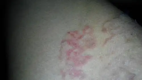 长在裆部有一个多月了很痒.