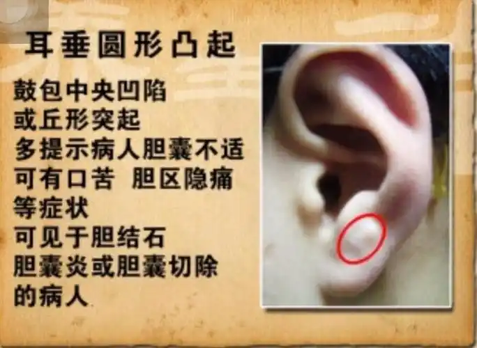 其它 神奇的耳诊 写美篇另外,我们可以看耳垂,从耳朵上诊断冠心病主要