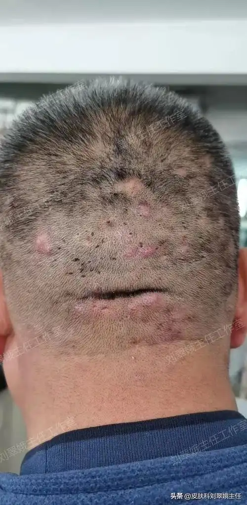 头上长红疙瘩(头上长红疙瘩毛囊炎图片)-尚蒂健康网