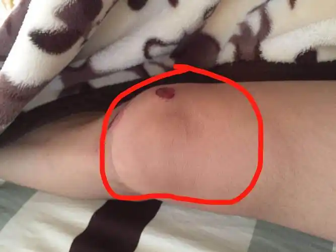 昨天骑车子摔倒后,膝盖一直肿痛,且稍微用点力或者弯曲都痛,整个腿用