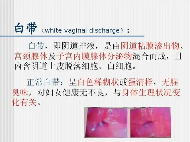 正常白带:呈白色稀糊状或蛋清样,无腥 臭味,对妇女健康蚊夥盐牡