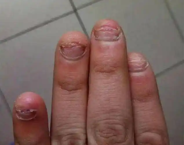 所以经常把指甲周围的皮肤咬破,导致指甲周围皮肤破损溃烂,引发甲沟炎