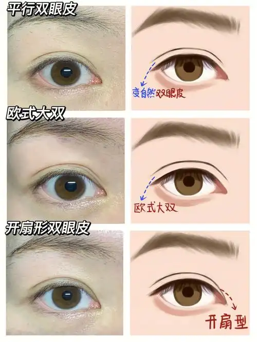 手把手教你如何贴不同类型的双眼皮教你轻松拥有不同类型的眼睛平行型