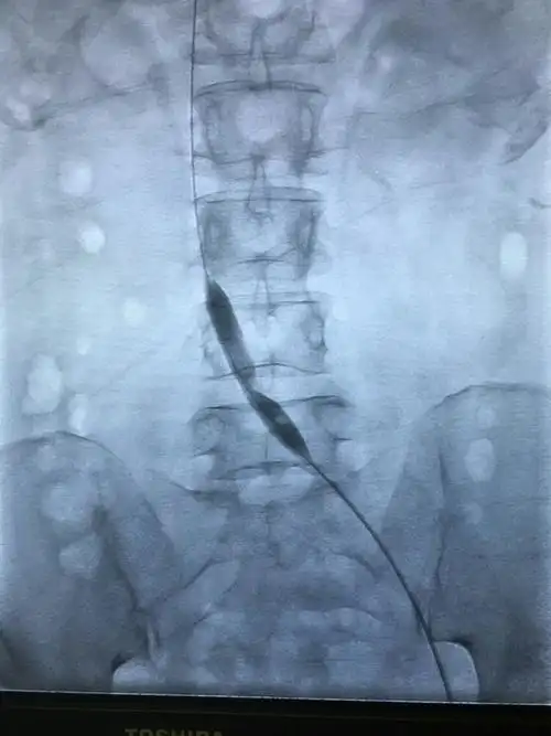 给予球囊扩张可见明显切迹