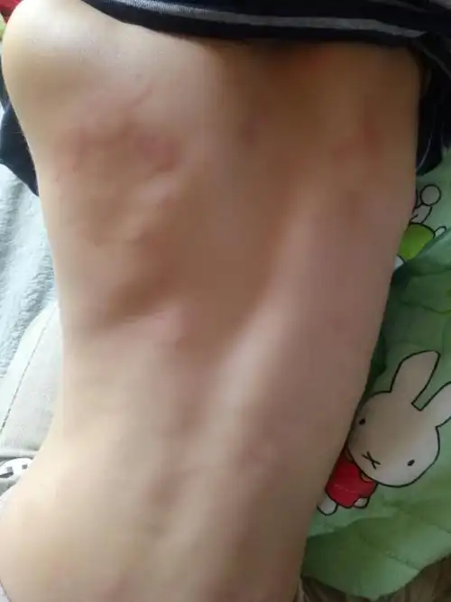 三岁的宝宝身上突然起这些东西 吃了过敏药也没用 有没有懂得