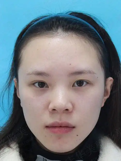 术前短鼻塌鼻鼻翼宽