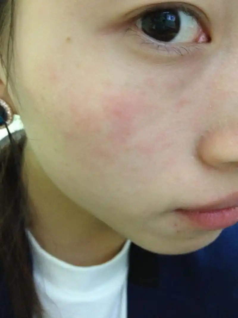 皮肤过敏发热怎么办 皮肤过敏发高烧怎么办