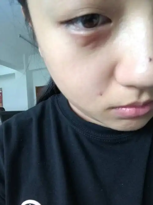 睡觉起来,一个眼睛肿了,感觉像好几个疙瘩,不疼也不痒,不是那种硬疙瘩