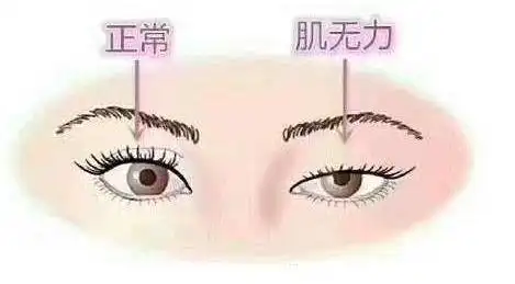 眼睛提肌无力图片