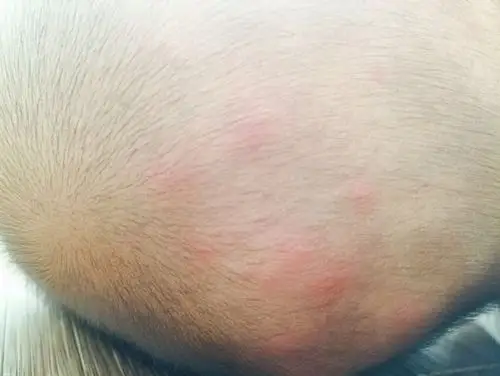 33333  推荐回答 你好,根据你的情况描述,及图片上看,考虑为毛囊炎