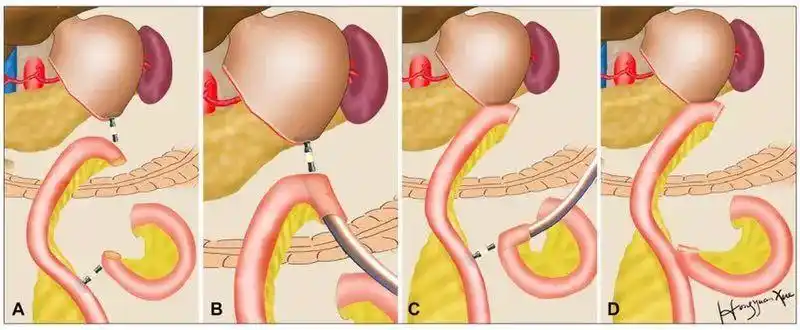 8,将管状吻合器置入腹腔前,应将相应肠袢预先摆放到拟行吻合的位置