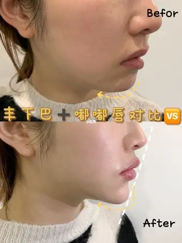 玻尿酸注射对比90_玻尿酸_嘟嘟唇_香肠_美妆_医美整形