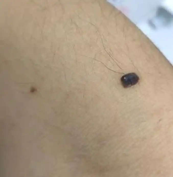 上万网友在身上找痣网红医生发博长这些地方都要切除