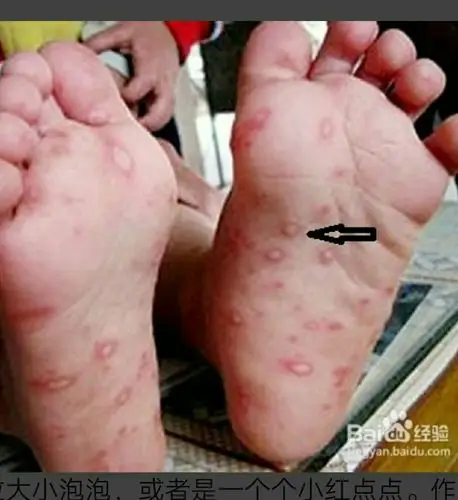 教您认识手足口病