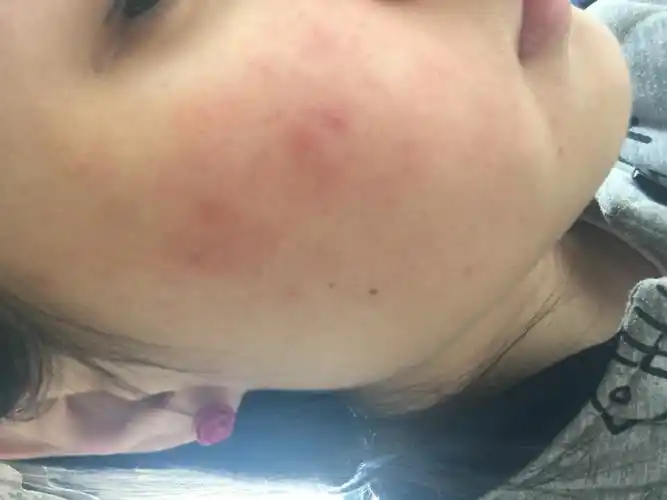 又不疼又不痒,就是有些干,有点脱皮_皮肤过敏_邻医网