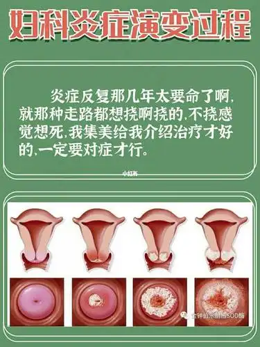 病毒感染下面我们来看看不同症状对应的妇科病俗话说白带是女性健康的