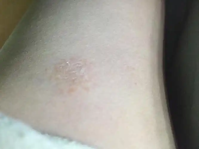 手臂上出现一块发皱红色的小块.不痛不痒.