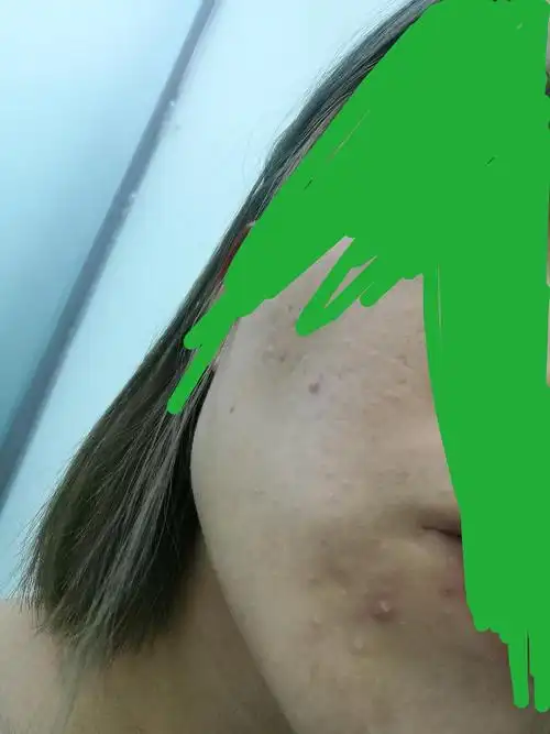 脸上长了很多一粒一粒的小米粒样的凸起,有的能挤出来白色东西,求解决